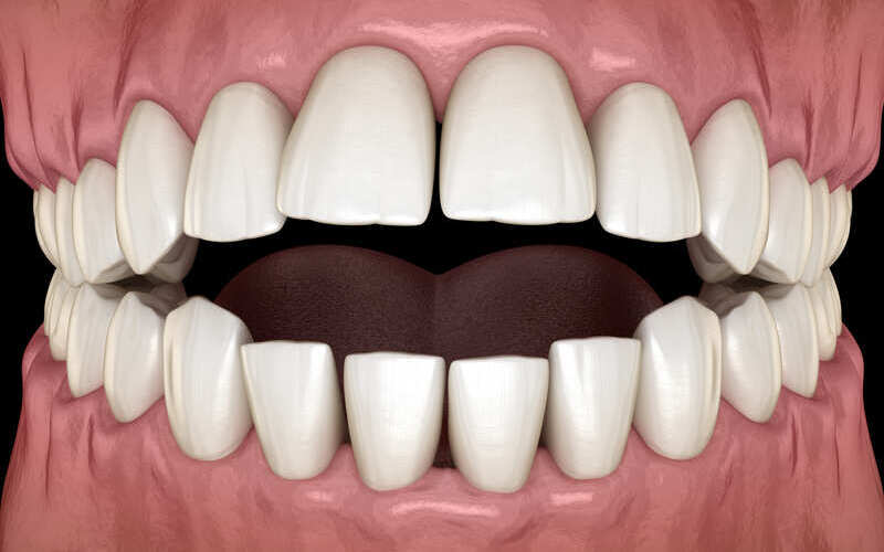 Mordida abierta anterior