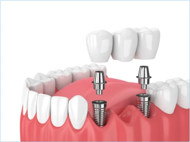 Un puente dental es una prótesis que se utiliza para reemplazar uno o varios dientes perdidos.