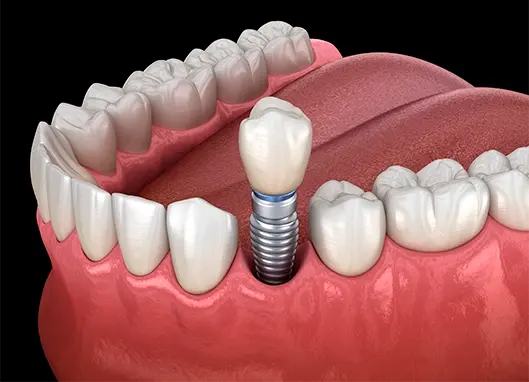 ¿Qué son los implantes de carga inmediata?