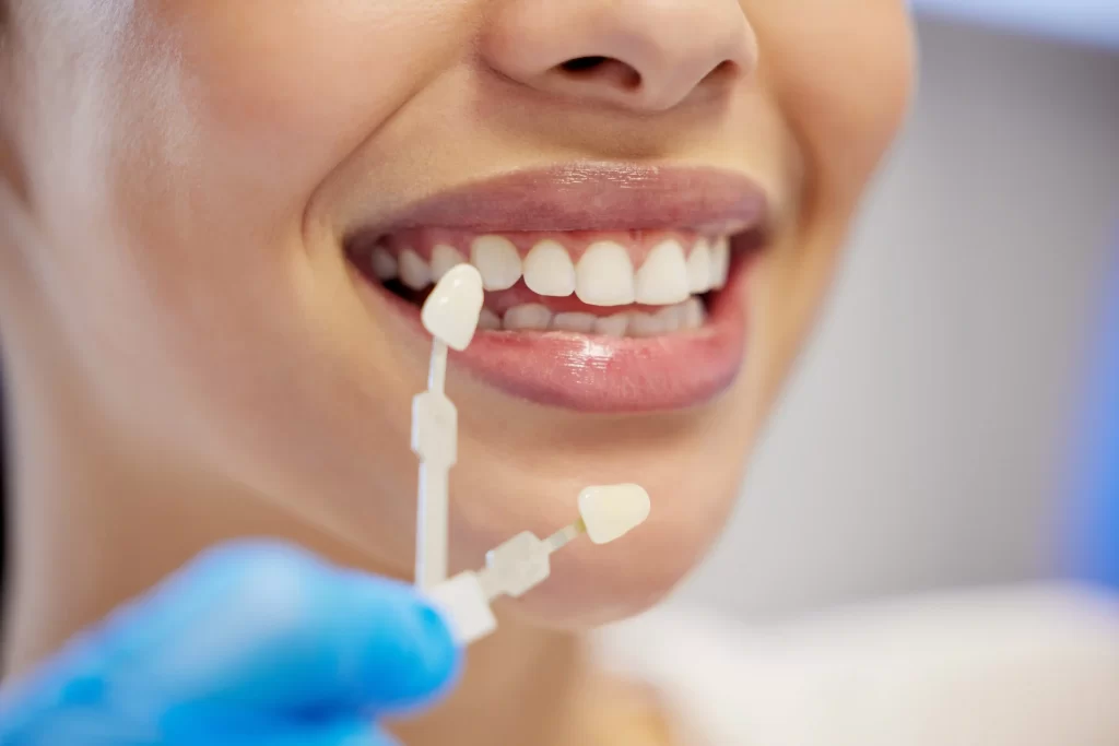 Tipos de carillas dentales
